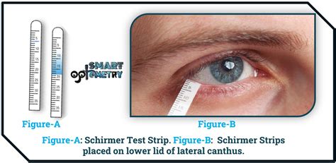 can you test tears|positive schirmer's test.